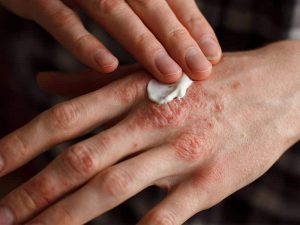 Womens hand eczema2